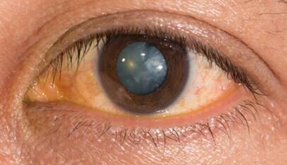 cost for eye laser treatment