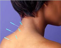acupuncture for pain in Morristown